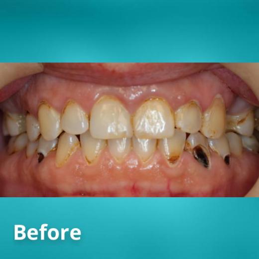 Before Teeth