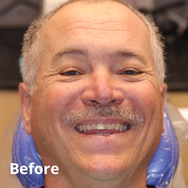 Before Teeth