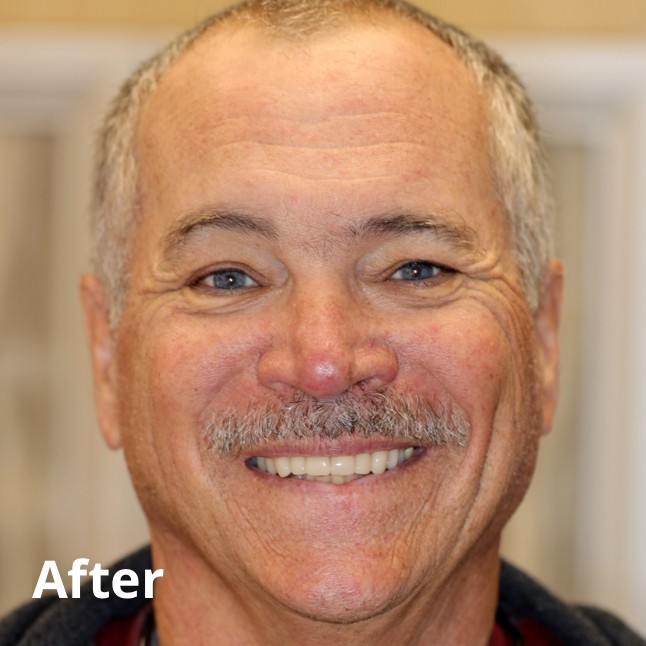 After Teeth