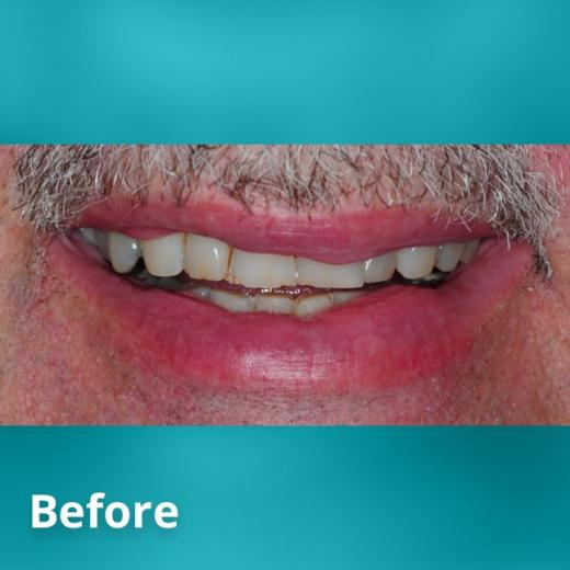 Before Teeth