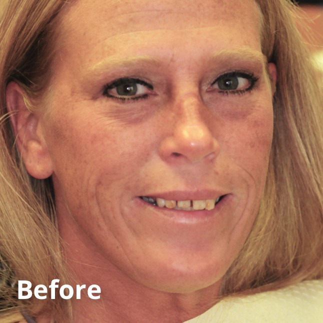 Before Teeth