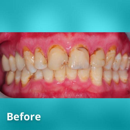 Before Teeth